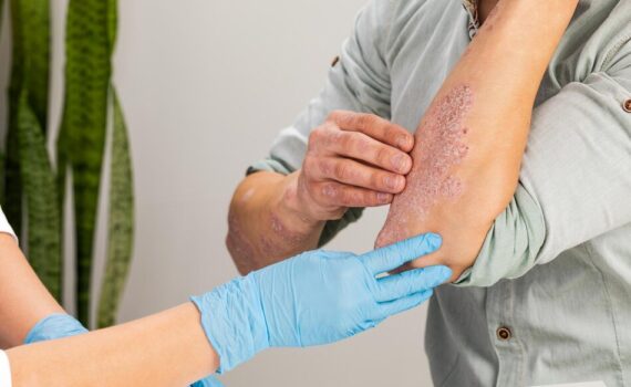 psoriasis treatment psoriasis treatment
