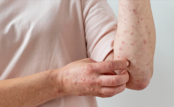 psoriasis treatment 01