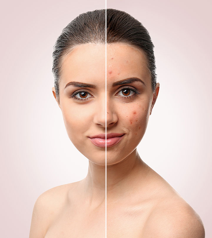 Acne and pimple care at Ayurvedam Clinic, Bhopal