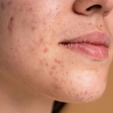 ACNE-and-Pimples ACNE and Pimples
