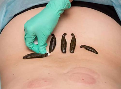 Leech-Therapy Leech Therapy