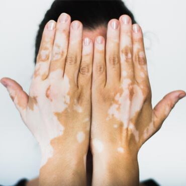 Leucoderma / Vitiligo Treatment in Bhopal Leucoderma / Vitiligo Treatment in Bhopal