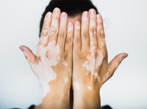 Leucoderma / Vitiligo Treatment in Bhopal