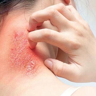 Ringworm-DAAD-Treatment psoriasis treatment clinic in bhopal