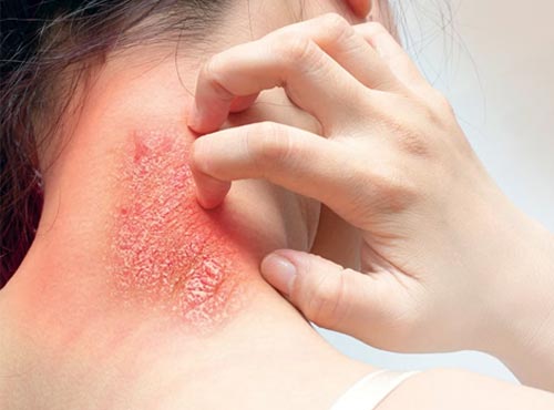 psoriasis treatment clinic in bhopal
