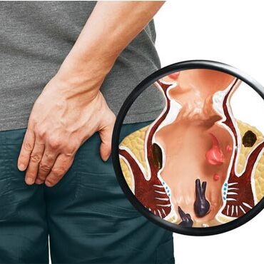 piles specialist in Bhopal** at Ayurvedam clinic. piles specialist in Bhopal** at Ayurvedam clinic.