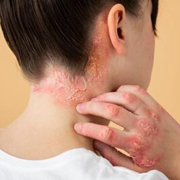 psoriasis-treatment psoriasis-treatment