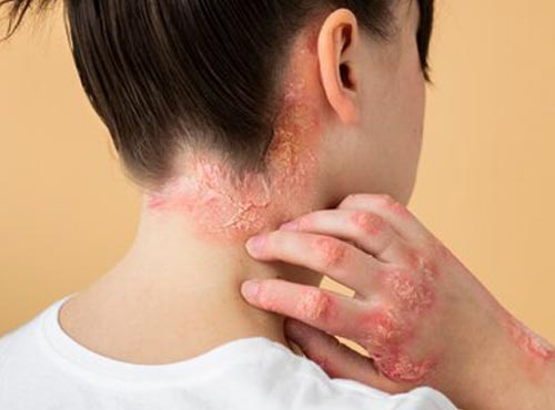 psoriasis-treatment psoriasis-treatment
