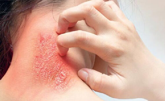 Ayurvedam Clinic – Ringworm / DAAD Treatment in Bhopal Ayurvedam Clinic – Ringworm / DAAD Treatment in Bhopal